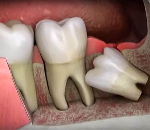 Story of Wisdom tooth