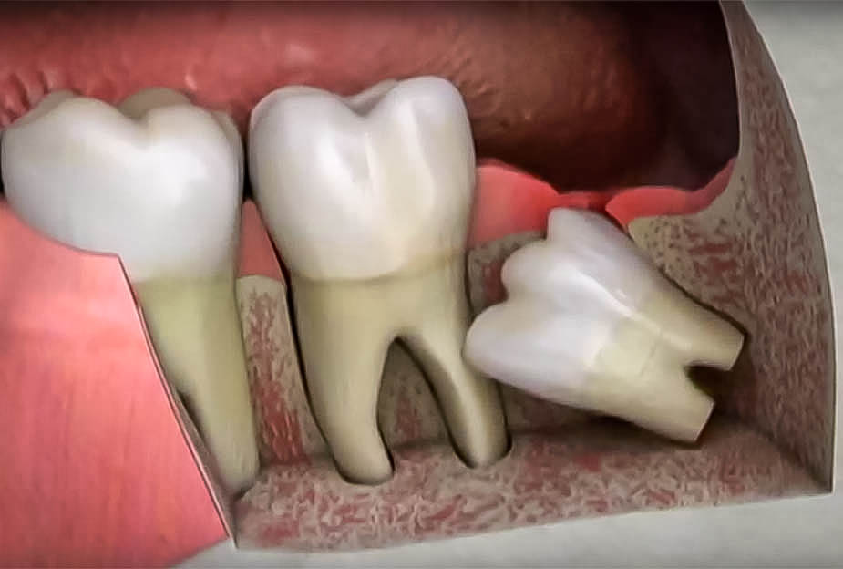 Story of Wisdom tooth