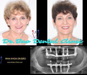 RESTORE ALL TEETH BY IMPLANT PROCEDURE (ALL ON 4 AND ALL ON 6)
