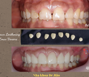 Smile transformation with Gum surgery and Emax Veneers
