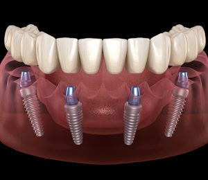 ALL ON 4 IMPLANT – Phương pháp phục hình cố định cho mất răng toàn hàm
