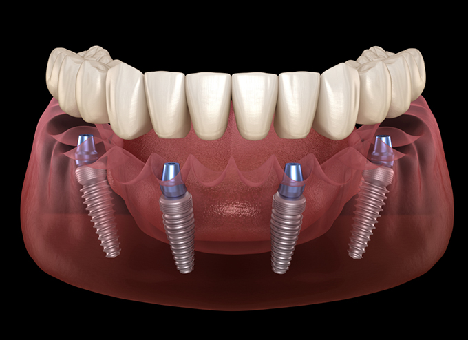 ALL ON 4 IMPLANT – Phương pháp phục hình cố định cho mất răng toàn hàm
