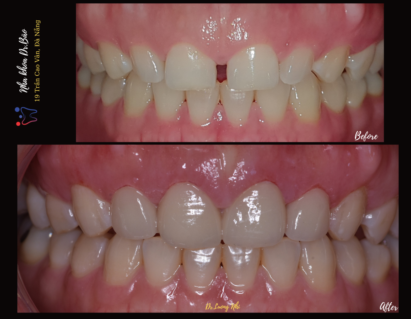 Mặt dán sứ veneer - Dr.Bão Clinic