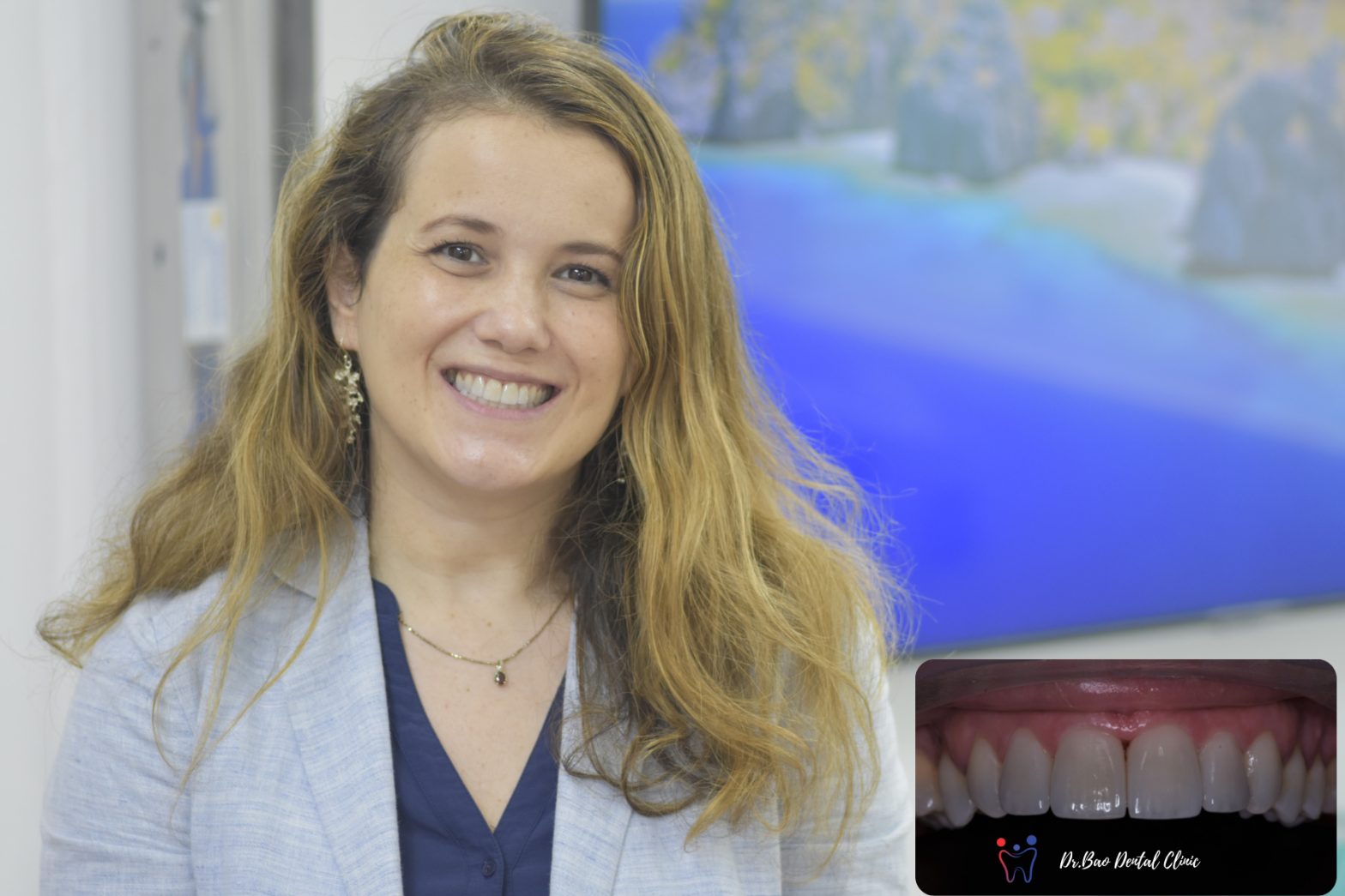 Mặt dán sứ veneer - Dr.Bão Clinic