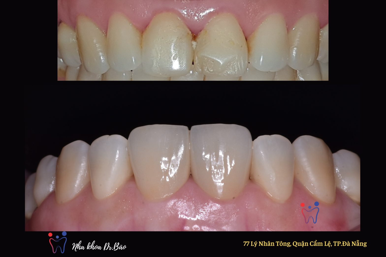 Mặt dán sứ veneer - Dr.Bão Clinic