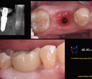 Răng cối bị hỏng được thay thế bằng răng implant như thật