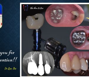 Phục hồi toàn miệng với Implant và mão răng