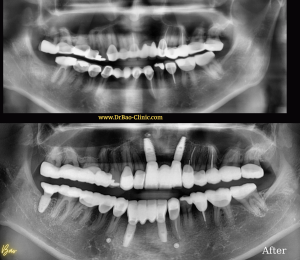 Full mouth rehalibitation – After 10 months!