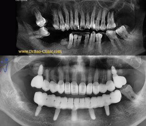 FULL MOUTH REHALIBITATION WITH IMPLANT ALL ON 5