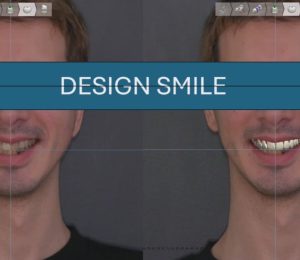 Restore a new smile by veneers and crowns