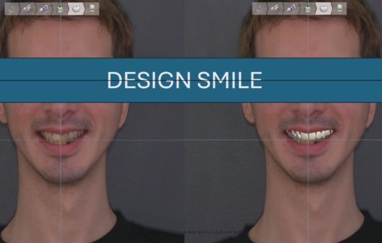 Restore a new smile by veneers and crowns