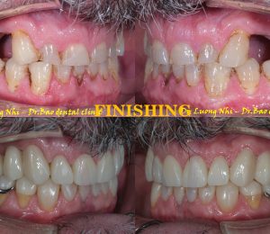 DON’T LET TEETH GRINDING RUIN YOUR SMILE