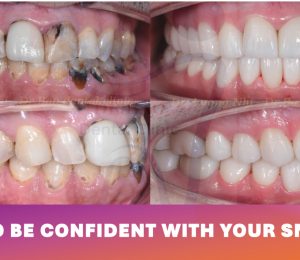 FULL-MOUTH REHABILITATION WITH ZIRCONIA CROWNS AND VENEERS