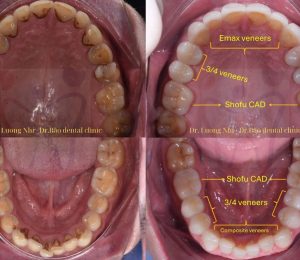 FULL-MOUTH RESTORATION WITH EMAX VENEERS