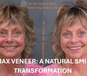 VENEER TREATMENT CASE: A NATURAL SMILE TRANSFORMATION