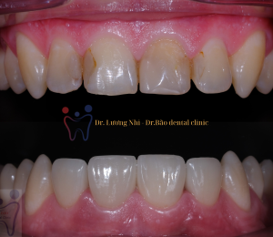 4 UPPER FRONT TEETH TRANSFORMATION: BEFORE & AFTER