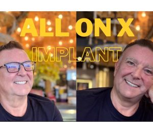 ALL ON X IMPLANT PROCEDURE – MR. ROGER EVE FROM ENGLAND