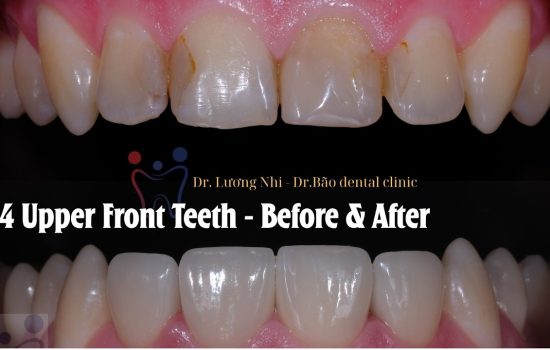 From Start to Finish: 4 Upper Front Teeth Transformation